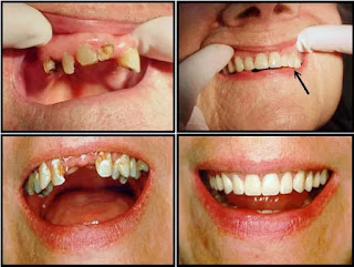 IMMEDIATE DENTURE